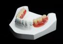 Spony na zubní protézy Indikace zapínání zubních protéz na sponách