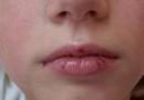 Лечение на напукани устни: домашни средства и витамини