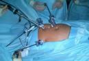 Následky a komplikácie po epidurálnej anestézii